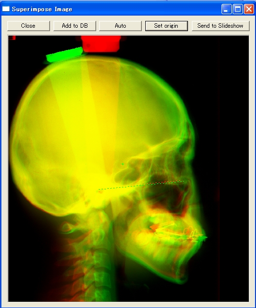 Superimpose Cephalogram images