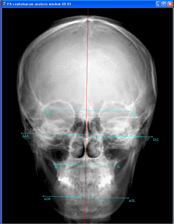 Superimpose Cephalogram images